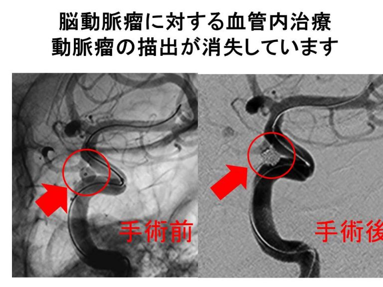 脳動脈瘤に対する血管内治療 動脈瘤の描出が消失しています