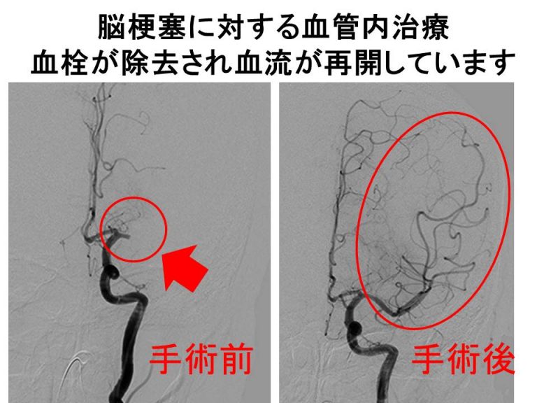 脳梗塞に対する血管内治療 血栓が除去され血流が再開しています