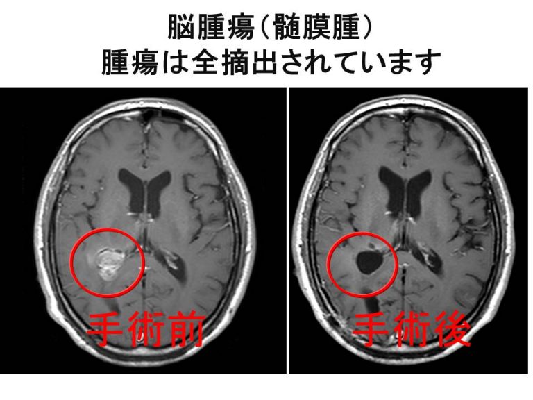 脳腫瘍（髄膜腫） 腫瘍は全摘出されています