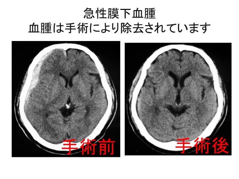 急性膜下血腫 血腫は手術により除去されています