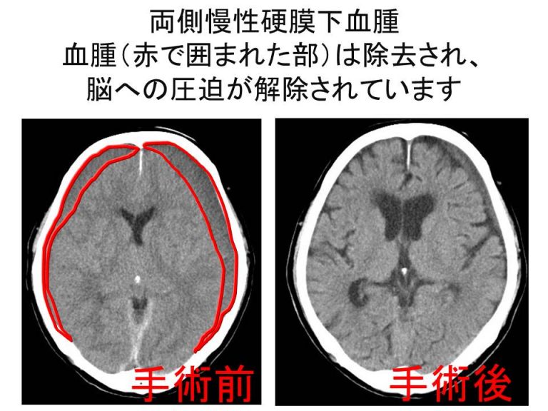 両側慢性硬膜下血腫 血腫（赤で囲まれた部）は除去され脳への圧迫が解除されています